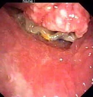 Опухоль пищевода с прорастанием в просвет трахеи. Атлас эндоскопических изображений endoatlas
